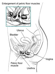 Side view diagram of female urinary tract with labels pointing to the uterus, bladder, pelvic floor muscle, urethra, and vagina. An inset shows an enlarged view of the pelvic floor muscles.